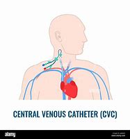 Image result for Central Venous Catheter Drawing