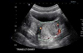 Image result for ovary cysts ultrasound images