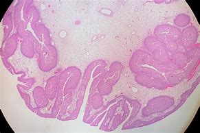 Image result for Nasal Squamous Papilloma