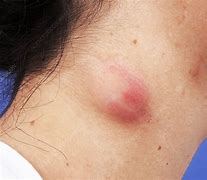 Image result for Sebaceous Cyst