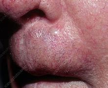 Image result for Basal Cell Carcinoma On Upper Lip
