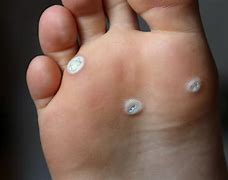 Image result for Verrucous Lesion Foot