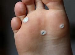 Image result for Planters Wart On Heel