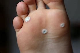 Image result for Plantar Warts On Soles of Feet