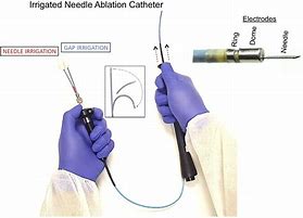 Image result for Ablation Needle