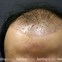 Image result for Fue Hair Transplant Donor Area