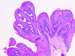Image result for Squamous Papilloma Neck