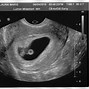 Image result for Triplets Ultrasound