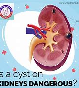 Image result for Cyst On Kidneys Symptoms
