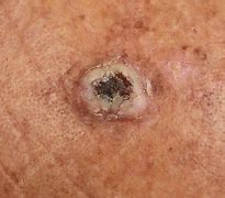 Image result for Squamous Cell Skin Cancer Scalp
