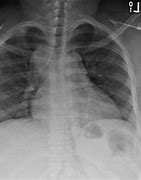 Image result for Non Calcified Lung Nodule