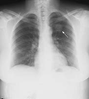 Image result for 2 Millimeter Lung Nodule