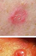 Image result for Basal Cell Carcinoma Back