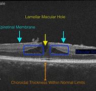 Image result for Stage 4 Macular Hole