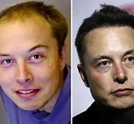 Image result for Elon Musk Hair Transplant