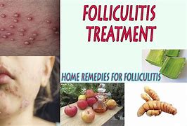Image result for Malassezia Folliculitis Treatment