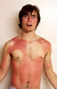 Image result for Full Body SunBurn