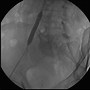 Image result for What Is an Angiogram On Shoulder