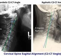 Image result for Cervical Spine Instability
