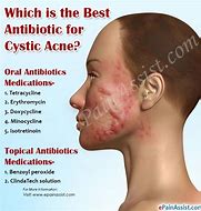 Image result for Acne Antibiotics