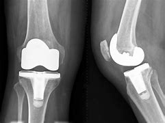 Image result for Pics of Knee Surgery