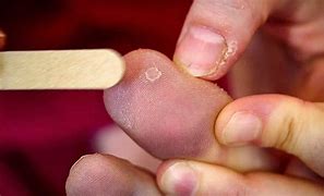 Image result for Wart Thumb Remove
