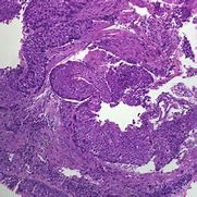 Image result for Nodules On Lungs in CT Scan