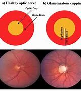 Image result for Optic Disc Cupping Glaucoma