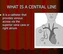 Image result for Central Arterial Line