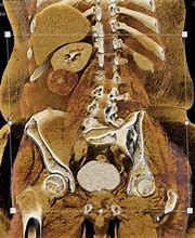 Image result for Renal Cyst CT