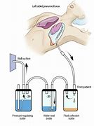 Image result for Chest Tube Parts