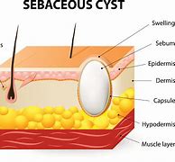 Image result for Small Sebaceous Cyst