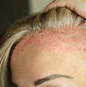 Image result for Eczema Forehead