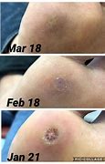 Image result for Dead Wart Removal