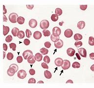 Image result for Hemoglobin C Trait