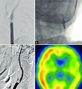 Image result for Carotid Artery in Neck