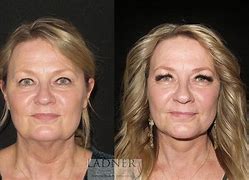 Image result for Facelift and Neck Lift Surgery