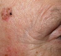 Image result for Warts On Genital Area