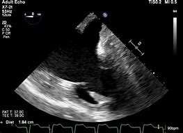 Image result for Dilated Coronary Sinus