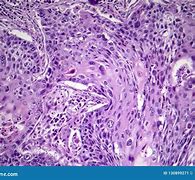 Image result for Squamous Cell Carcinoma Lung