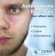 Image result for Autoimmune Skin Eruptions