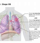 Image result for Stage 3A Cancer