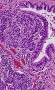 Image result for Neuroendocrine Tumor