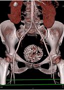 Image result for Calcified Uterine Fibroid