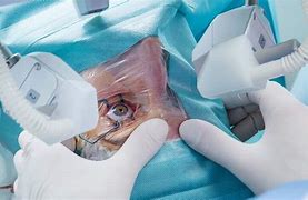 Image result for PRK Eye Procedure