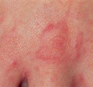 Image result for Scabies Pattern