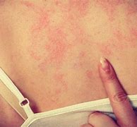 Image result for Allergy Rash On Back
