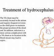 Image result for Hydrocephalus Treatments