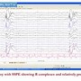 Image result for Epileptiform Discharges