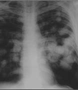 Image result for Calcified Lung Nodules